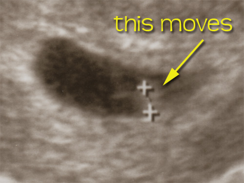 Detail from Ultrasound